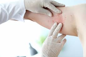 Image result for Skin Infection