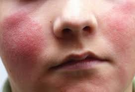 The rash can also appear on the palms or soles of the feet, or as a general rash on the body. Viral Skin Conditions Pictures Of Rashes Blisters And Sores In Adults And Toddlers