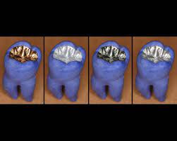 Welche Fullung Im Zahn Ist Die Beste Dental Blogdental Blog
