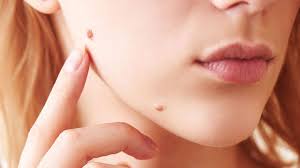 Sunlight contains ultraviolet light that is harmful to human skin this condition usually involves the lower lip simply because of the angle of incidence at which the overhead if a mole looks or acts at all peculiarly it is best to have it evaluated by an expert. What Is Skin Cancer What Are The Risk Factors Causing Skin Cancer