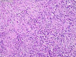 B, sarcomatoid malignant mesothelioma shows malignant spindle cells lying within fibrous stroma. Webpathology Com A Collection Of Surgical Pathology Images