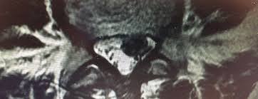 It usually gets better slowly with rest, gentle exercise and painkillers. Lumbar Disk Disease Herniated Disk Johns Hopkins Medicine