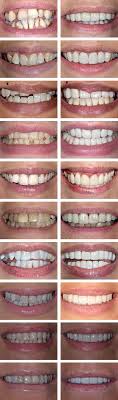 The third appointment fixes the veneers, and the teeth are cleaned to make it shining white. New Crooked Teeth Solutions And Treatments The Perfect Smile