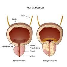 Breast cancer is the second most common cancer found in women — after skin cancer — but that doesn't mean men aren't at risk as well. Prostate Cancer Symptoms And Treatments Urology Experts Dr Alejandro Miranda Sousa