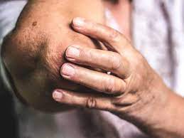 Characterized by dark purple blotches of irregular form and size, the benign lesions are purely cosmetic lesions and typically a source of embarrassment. Senile Purpura Vitamin K Natural Remedies And Treatments