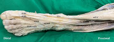 We did not find results for: Left Leg The Ehc Tendon Was Dissection In Ta Tendon And Ehl Tendon Download Scientific Diagram