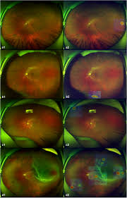 A retinal tear, or retinal detachment, occurs when the retina is torn from the underlying tissue. Representative Optos Images And Corresponding Heatmaps Of Download Scientific Diagram