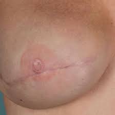 Breast reconstruction surgery is designed to restore the volume and shape of the breast after mastectomy. A More Accessible Way To Do Nipple Tattoos Post Mastectomy Inside Out