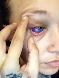 Surgical removal, also called excision tattoo removal, involves cutting off tattooed skin and stitching remaining skin back together. Canadian Model Who Had Her Eyeball Tattooed Might Have To Have It Removed After It Went Horribly Wrong