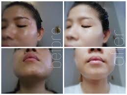 Missy Forward Beauty Acne Alert Solution With Eucerin