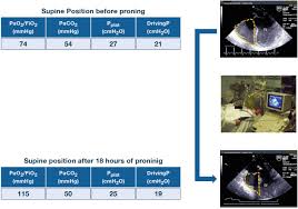 Image result for Proning