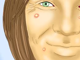 Biweekly or monthly treatments are typically advised for treating moderate skin complaints. How To Prepare For A Microdermabrasion 15 Steps With Pictures