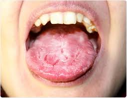 Find patient medical information for cefdinir oral on webmd including its uses, side effects and safety, interactions, pictures, warnings and user ratings. Oral Candidiasis Oral Thrush
