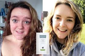 Student claims she's found a bizarre 'cure' for the agonising psoriasis  left her a recluse