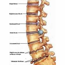Téléchargez cette image gratuite à propos de colonne vertébrale disque de la vaste bibliothèque d'images et de vidéos du domaine public de pixabay. La Decompression Neurovertebrale Florent Schoofs Osteopathe Paris 7