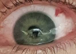 Image result for lesion sclera