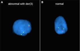 Duplication of 3p the disorder was first described in the medical literature in 1972 (rethore 1972). Mosaic Deletion Duplication Syndrome Of Chromosome 3 Prenatal Molecular Cytogenetic Diagnosis Using Cultured And Uncultured Amniocytes And Association With Fetoplacental Discrepancy Sciencedirect