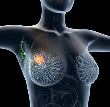 Brustkrebs Mammakarzinom Symptome Therapie Und Reha