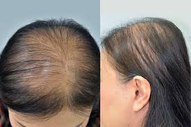 Its regular use will regrow your lost hair and stop further loss. Baldness Treatment 11 Best Home Remedies To Cure Baldness