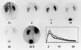 Image result for Helical CT Urogram