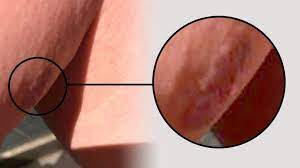 Most people have experienced lumps in some form, especially if they're older. My Beautician Saved My Life From Deadly Skin Cancer Bbc News