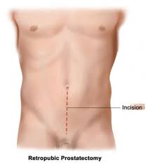 Image result for Radical Prostatectomy