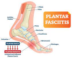 Keadaan ini adalah paling sakit sangat bila pijak lantai. Sakit Tumit Kaki Antara Plantar Fasciitis Atau Heel Spurs Penyebabnya