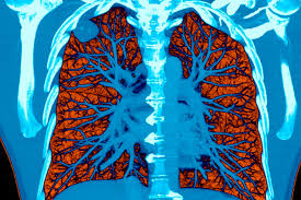 Coughs, colds, wheezing and asthma are just the start. A I Took A Test To Detect Lung Cancer It Got An A The New York Times
