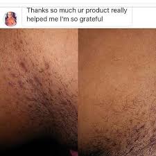 Treating genital herpes is more complicated because the sores are very infectious and there is no cure for the virus that causes blisters around. Ingrown Hair Scars Ingrown Pubic Hair