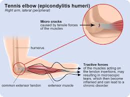 Pin On Elbow Pain Remedies
