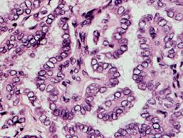 It often has psammoma bodies (derived from the greek psammos, or sand): Step Cancers And Tumor Markers Flashcards Quizlet