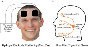 Electrical stimulation of the trigeminal nerve improves olfaction in  healthy individuals: A randomized, double-blind, sham-contr