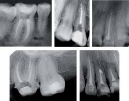 Se presenta en algunas personas con un sistema inmunitario debilitado. Paciente Endodontico Con Mucormicosis Rinocerebral Reporte De Un Caso Sciencedirect