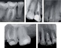 Mucormicosis rinocerebral se presenta principalmente en pacientes con leucemia, en quienes los macrófagos alveolares no eliminan las. Paciente Endodontico Con Mucormicosis Rinocerebral Reporte De Un Caso Sciencedirect
