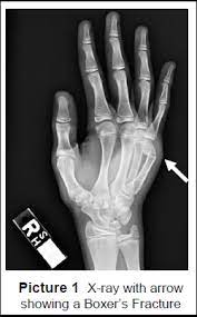 Symptoms include pain and a depressed knuckle. Boxer S Fracture