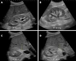 Acute renal failure in children: Point Of Care Renal Ultrasonography For The Busy Nephrologist A Pictorial Review