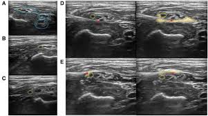 Image result for Superior Trunk Block