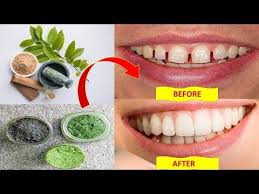 How To Fix Gap Between Teeth Naturally At Home Without Braces Health Pavilion Bright Side By Health Pavilion