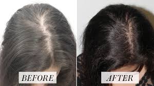 Hair loss can occur at any age, in males and females, and can have many different causes including underlying medical conditions. Platelet Rich Plasma Treatment For Hair Loss Here S What To Know Allure