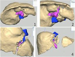 Learn vocabulary, terms and more with flashcards, games and other study tools. Lateral Segmentectomy Of The Liver Using A Virtual 3d Model 1 Download Scientific Diagram