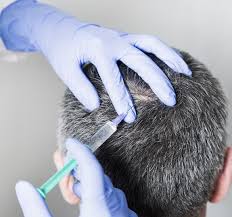 Your best bet is to use men's rogaine 5 rogaine is the best otc treatment for hair loss in men who are suffering from androgenetic alopecia, a.k.a. Hair Mesotherapy Hair Loss Hair Care Hair Mesotherapy Prices Hair Loss Treatment