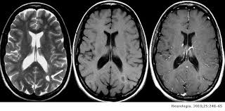 Esclerosis múltiple por resonancia magnética por imágenes (rmi). Recomendaciones Para La Utilizacion E Interpretacion De Los Estudios De Resonancia Magnetica En La Esclerosis Multiple Neurologia