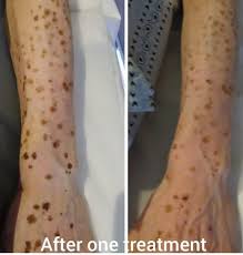 Image result for liver spots on legs