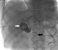Additional operation of biliary tract: Percutaneous Transhepatic Biliary Drainage Ptbd With Placement Of A Download Scientific Diagram