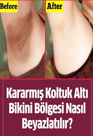 Koltuk Alti Beyazlatma Icin Dogal Yontemler 2020 Koltuk Alti Cilt Beyazlatma Cilt Rengi