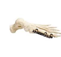 Mini Rails - OrthoPediatrics