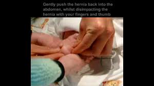 Image result for Inguinal hernia child