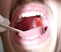 Image result for Peritonsillar Abscess