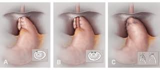 Image result for Pediatric Reflux