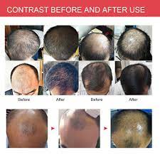 Frequent use of soft infrared in radiating hair follicles can accelerate hair growth,and strengthen the. Infrared Laser Hair Growth Cap Helmet Anti Hair Loss Hair Fast Regrowth Therapy Ebay